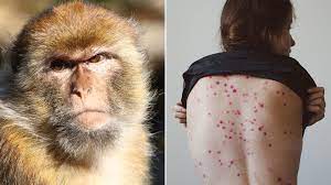 Todo lo que hay que saber sobre la viruela del mono: qué es la rara enfermedad que preocupa a Europa y EEUU